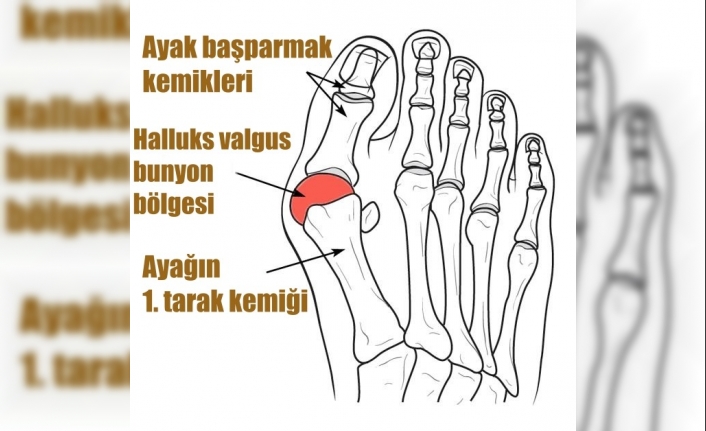 Dar ve sivri burunlu ayakkabılar şekil bozukluğuna sebep oluyor