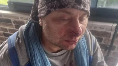 “Felaket Tellalı” Onur Akay’a Pitbull Saldırısı: Burnundan Parça Koptu